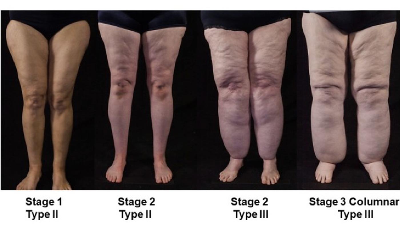 Lipoedema stages and types