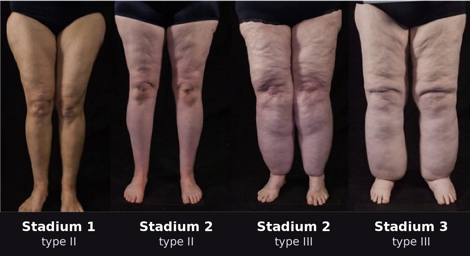 Stadia en typen van lipoedeem: stadium 1 tot en met 3